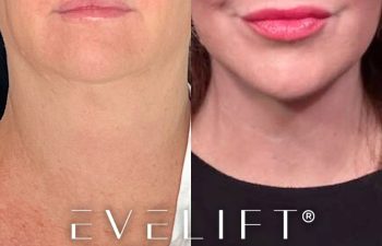 female patient before and after EVELift®
