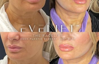 female patient before and after EVELift®