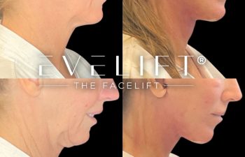 female patient before and after EVELift®