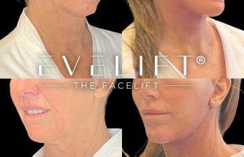 female patient before and after EVELift®