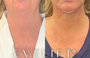 female patient before and after EVELift®