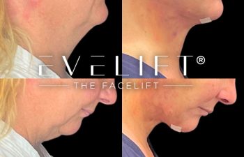 female patient before and after EVELift®