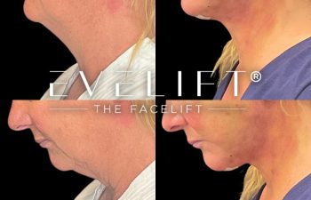 female patient before and after EVELift®
