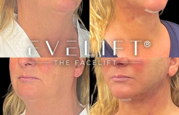 female patient before and after EVELift®