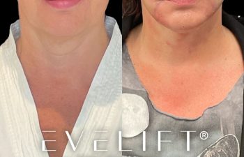 female patient before and after EVELift®