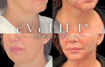 female patient before and after EVELift®