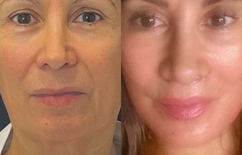 female patient before and after EVELift®