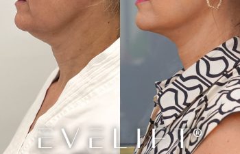 female patient before and after EVELift®