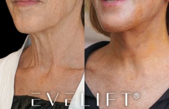 female patient before and after EVELift®