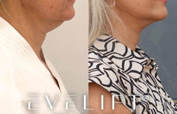 female patient before and after EVELift®