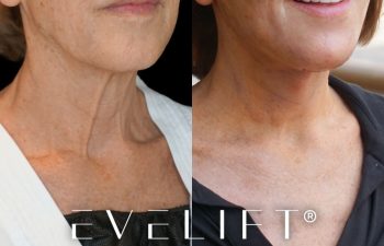 female patient before and after EVELift®