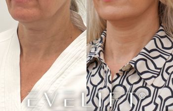 female patient before and after EVELift®
