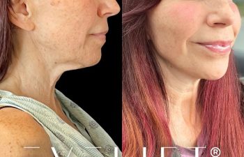 female patient before and after EVELift®