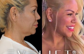 female patient before and after EVELift®