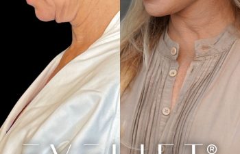 female patient before and after EVELift®