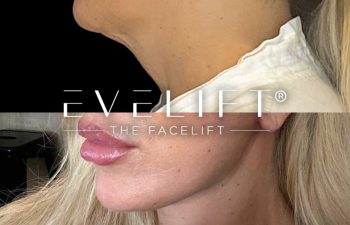 female patient before and after EVELift®
