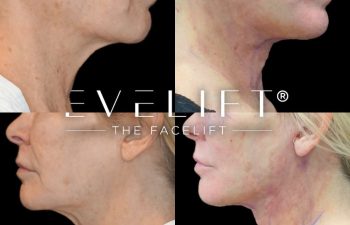 female patient before and after EVELift®