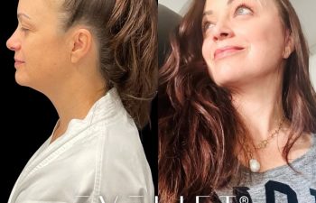 female patient before and after EVELift®