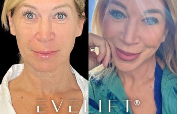 female patient before and after EVELift®