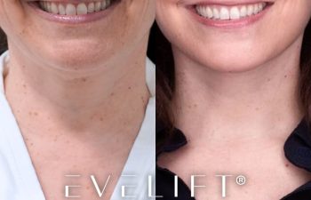 female patient before and after EVELift®