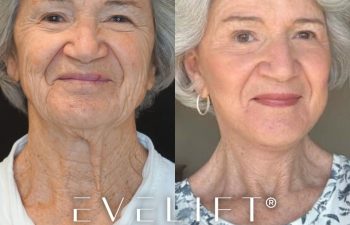 female patient before and after EVELift®