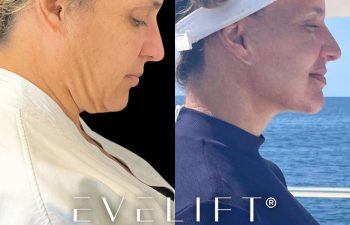 female patient before and after EVELift®