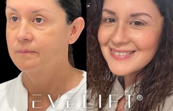 female patient before and after EVELift®