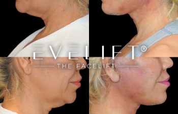 female patient before and after EVELift®