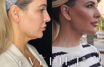 female patient before and after EVELift®