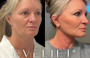 female patient before and after EVELift®