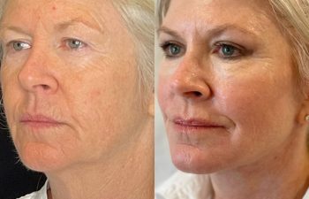 female patient before and after EVELift®