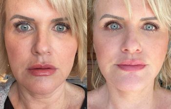 female patient before and after EVELift®