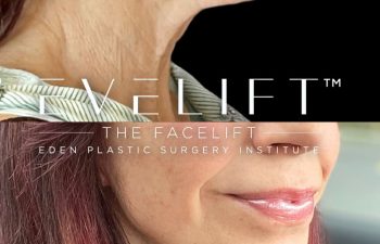female patient before and after EVELift®