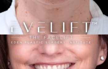 female patient before and after EVELift®