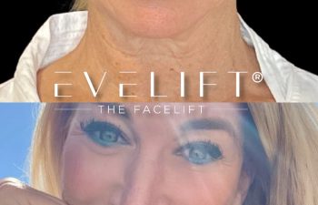 female patient before and after EVELift®