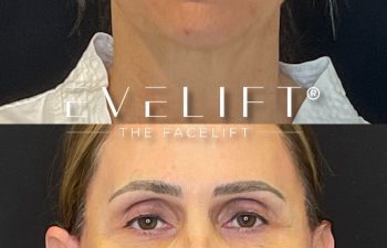 female patient before and after EVELift®