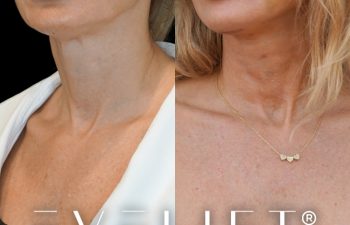 female patient before and after EVELift®