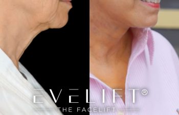 female patient before and after EVELift®