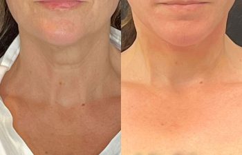 female patient before and after EVELift®