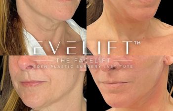 female patient before and after EVELift®