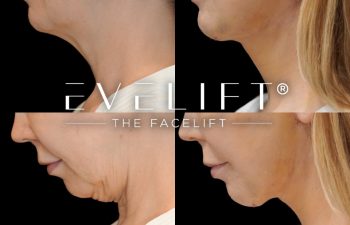 female patient before and after EVELift®
