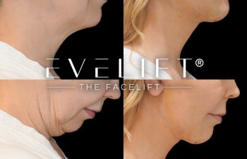 female patient before and after EVELift®