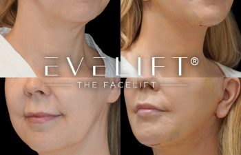 female patient before and after EVELift®