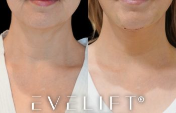 female patient before and after EVELift®