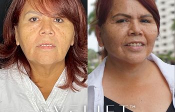 female patient before and after EVELift®