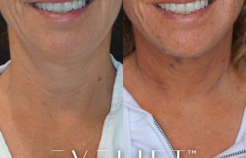 female patient before and after EVELift®