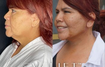 female patient before and after EVELift®