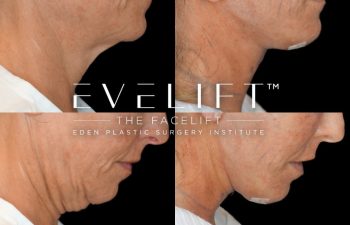 female patient before and after EVELift®