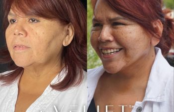 female patient before and after EVELift®