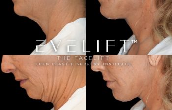 female patient before and after EVELift®
